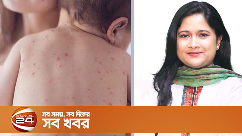 শিশু হাম আক্রান্ত হলে কী খাওয়াবেন, কী খাওয়ানো যাবে না, জানালেন পুষ্টিবিদ